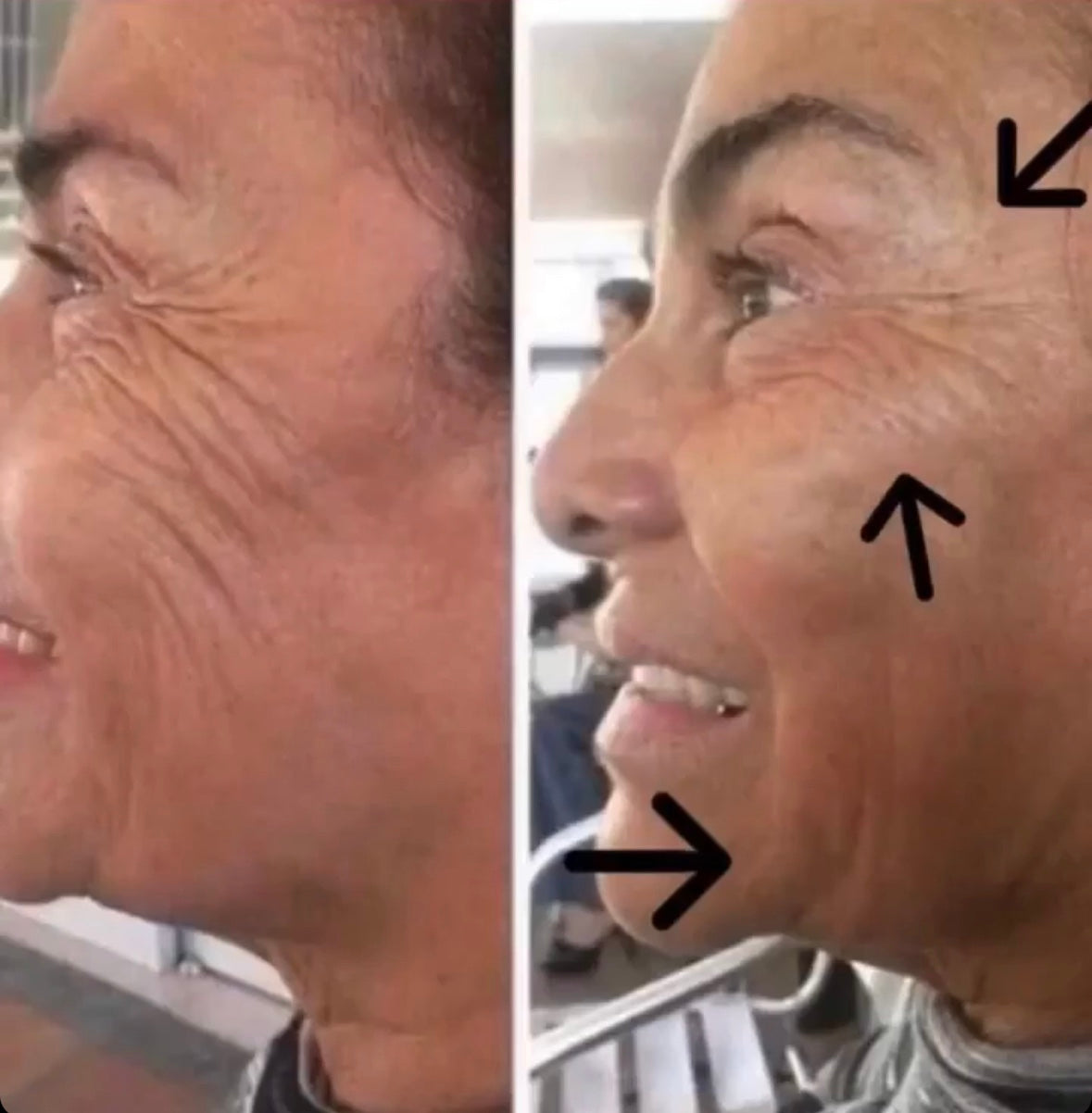 Side-by-side close-up of an older woman’s face before and after treatment, with arrows highlighting visible wrinkle reduction around the eyes, cheeks, and jawline.