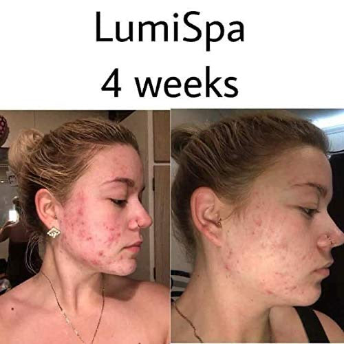 Side-by-side facial comparison of a woman before and after 4 weeks of using LumiSpa, showing visible improvement in acne and skin texture.