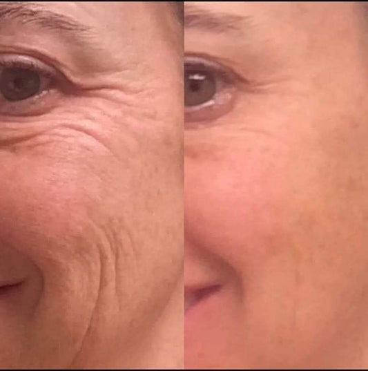 Close-up side-by-side comparison of an older woman’s eye area showing visible reduction in wrinkles and fine lines after treatment.